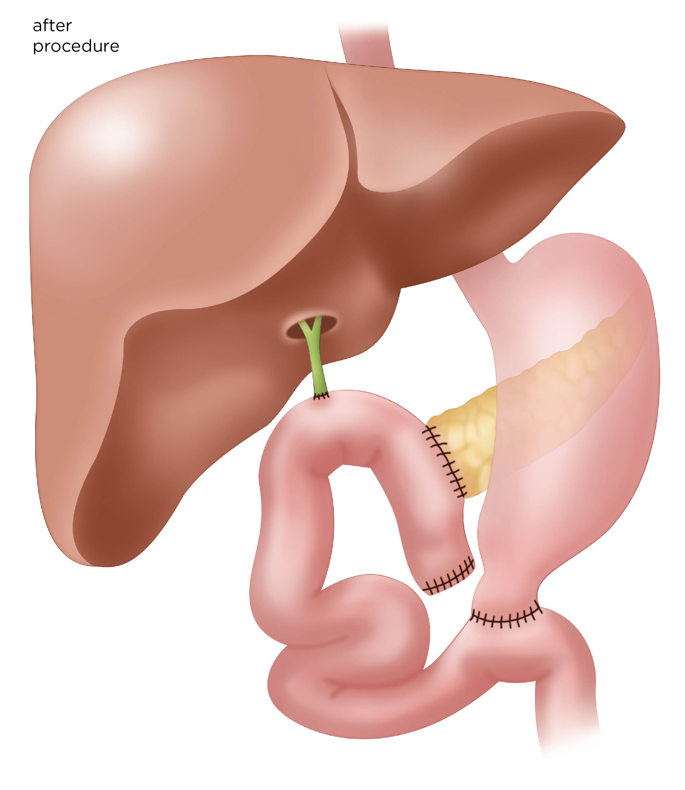 whipple-procedure-steps-indications-complications-recovery