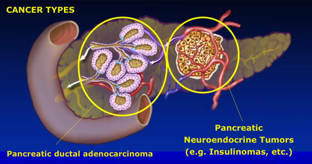 Staging - Hirshberg Foundation for Pancreatic Cancer Research