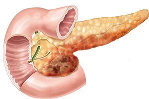 Inflammation of the pancreas
